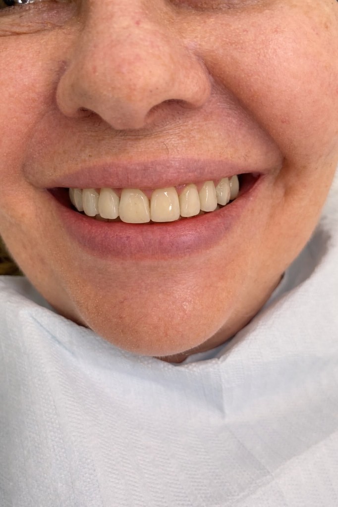 Depois — Facetas