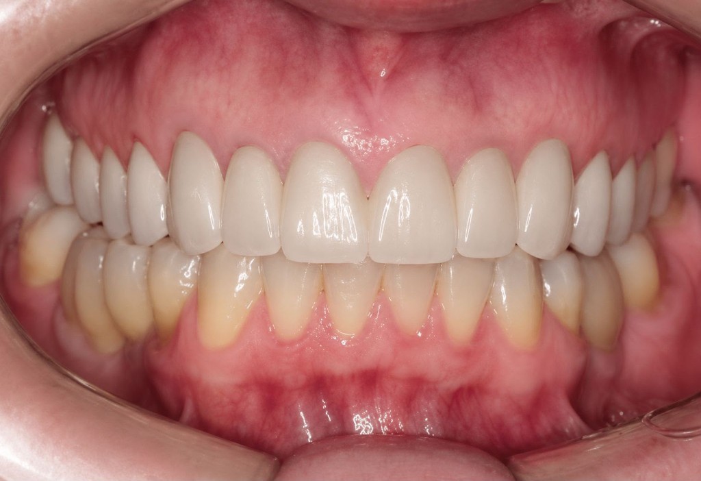 Depois — Facetas e lentes