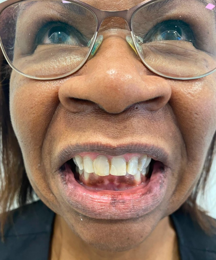 Antes — Facetas e lentes