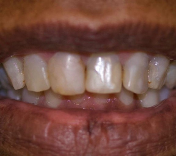 Antes — Facetas e lentes